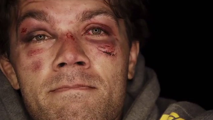 Face of a warrior ... Team Australia's Chris Indich shows the scars of battle following his bout with Chad Laprise.