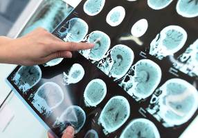 The early stages of Alzheimer's can be detected years in advance. 
