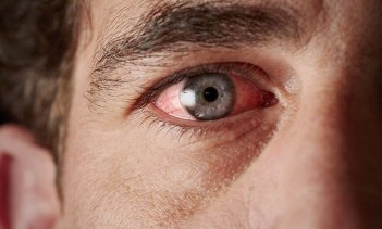red-eyes