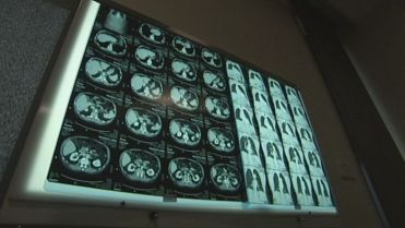 'Spectacular' results offer new hope for sufferers of one of Australia's most deadly cancers