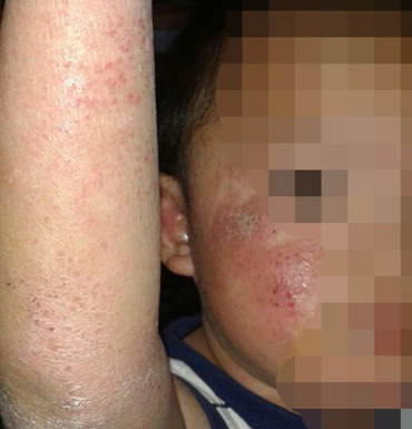 The family of this asylum seeker boy are concerned his skin infection will not receive treatment in Malaysia.