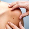 skin-cancer-check
