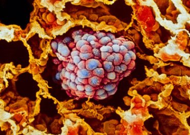 lung cancer cell