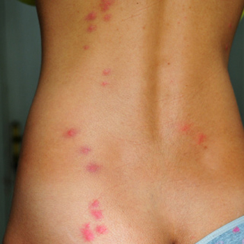 Bed bug bites can be nasty. Photo: Getty