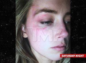 A photo of the alleged injuries obtained by TMZ