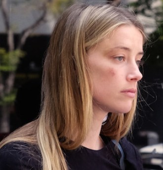 Amber Heard leaving court with a bruise on her face. Photo: AAP