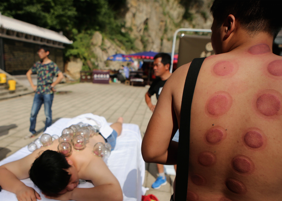 what is cupping