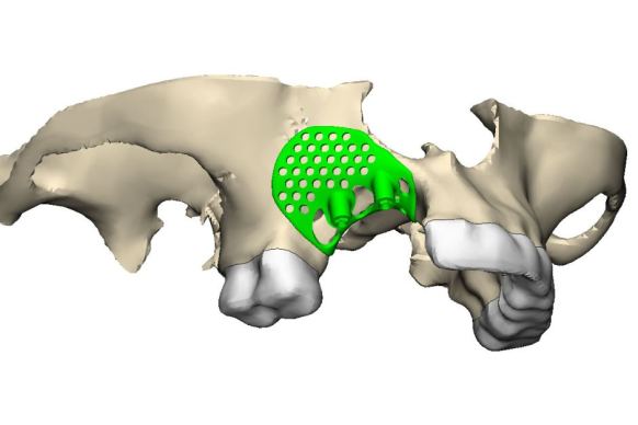 A scan of Susie Robinson's jaw with the 3D-printed implant