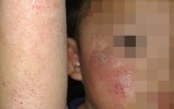 The family of this asylum seeker boy are concerned his skin infection will not receive treatment in Malaysia.