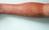 Measles outbreak