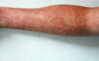 Measles outbreak