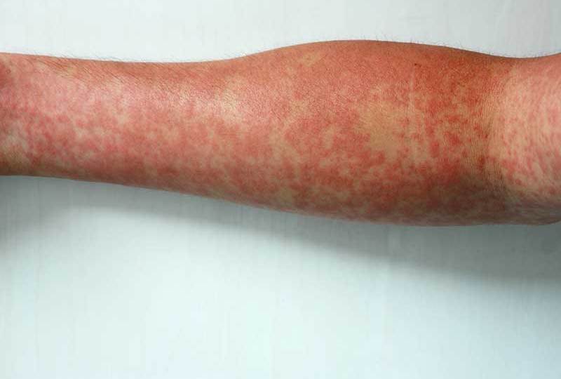 Measles outbreak