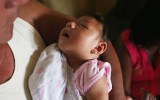 microcephaly zika virus