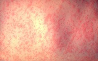 Measles