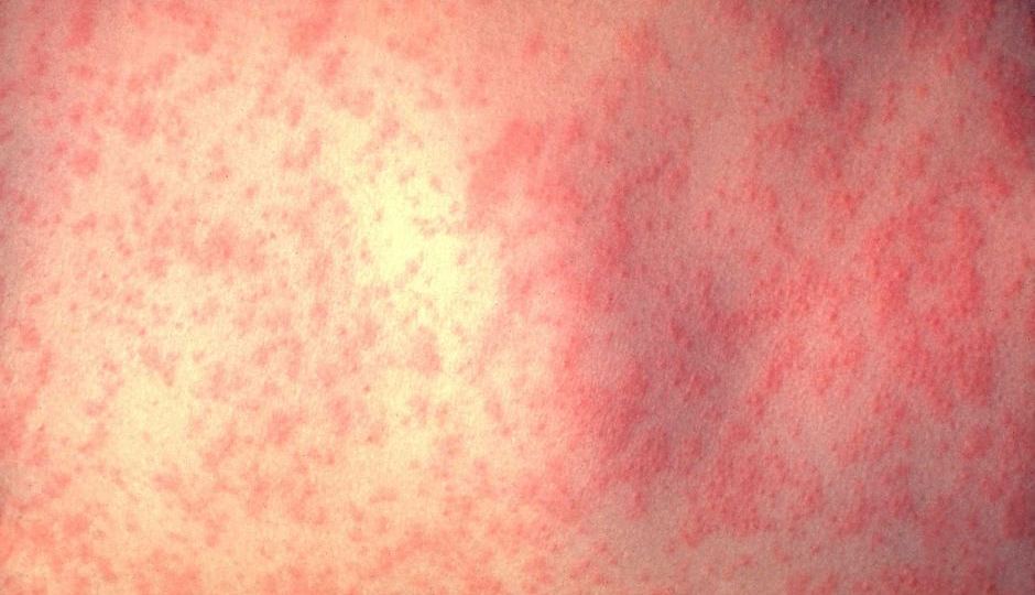 Measles