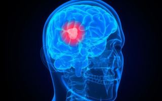 brain cancer scan