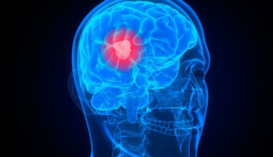 brain cancer scan