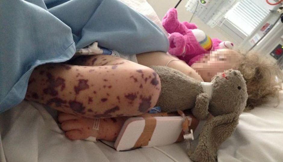 Young girl with meningococcal rash