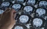Alzheimer's disease blood test