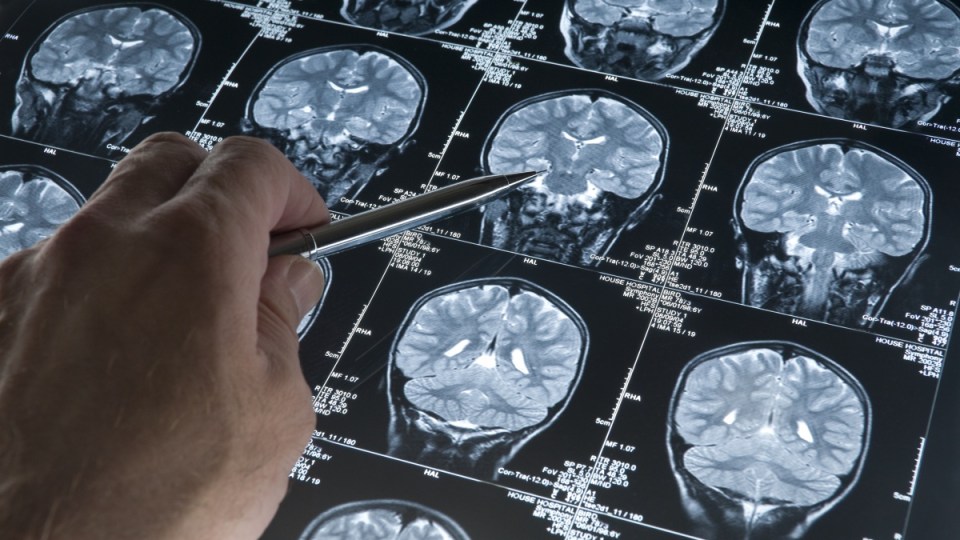 Alzheimer's disease blood test