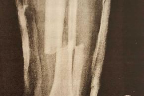 X-ray of Adam Bart's broken leg