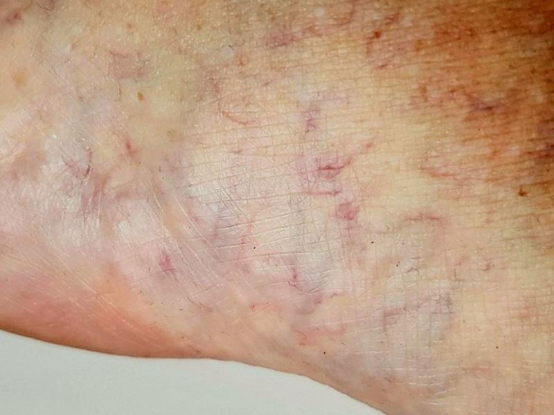 hookworm feet