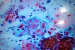 Abnormal cells in cervical screening test