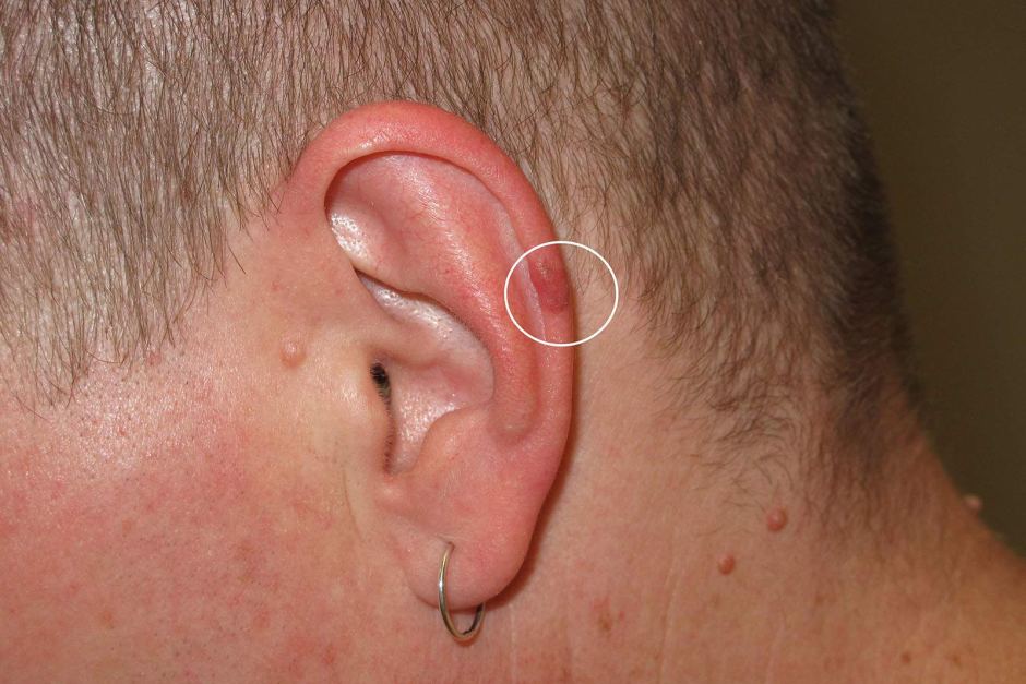 Melanoma