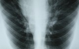 lung cancer detection test