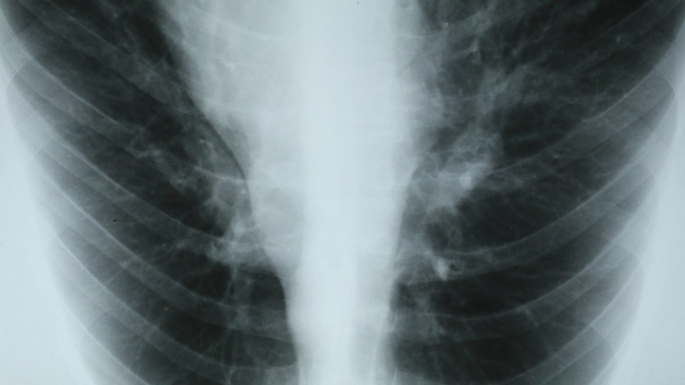 lung cancer detection test