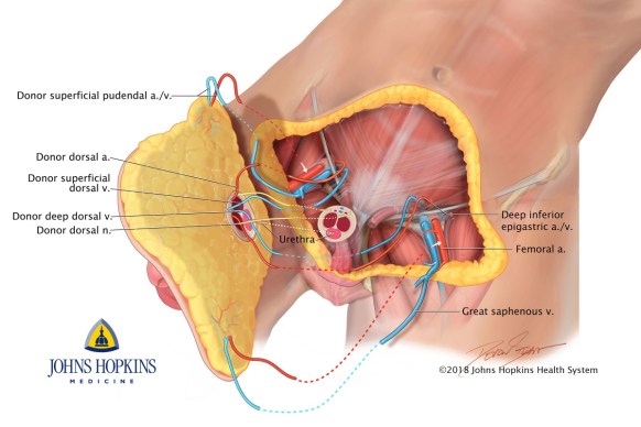 penis transplant