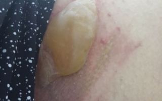 Second-degree burns on Qantas passenger's leg