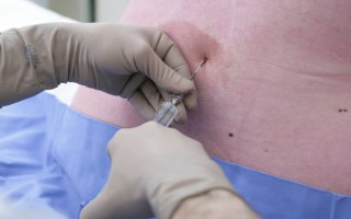 Epidural