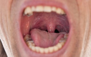 tonsils adenoids