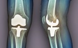 xray knee replacement