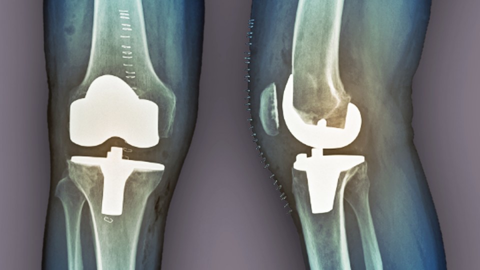xray knee replacement