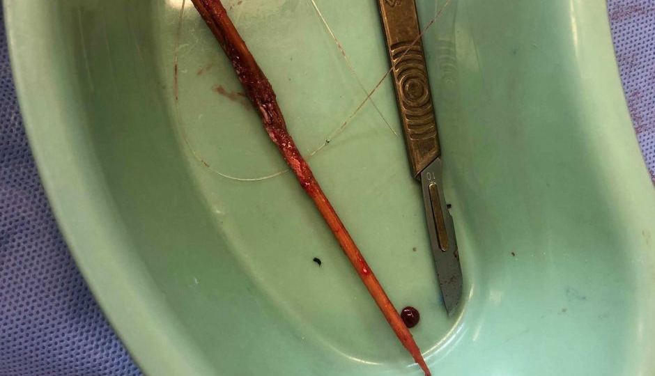 The daughters were taken overseas for genital mutilation surgery.