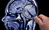 Dementia
