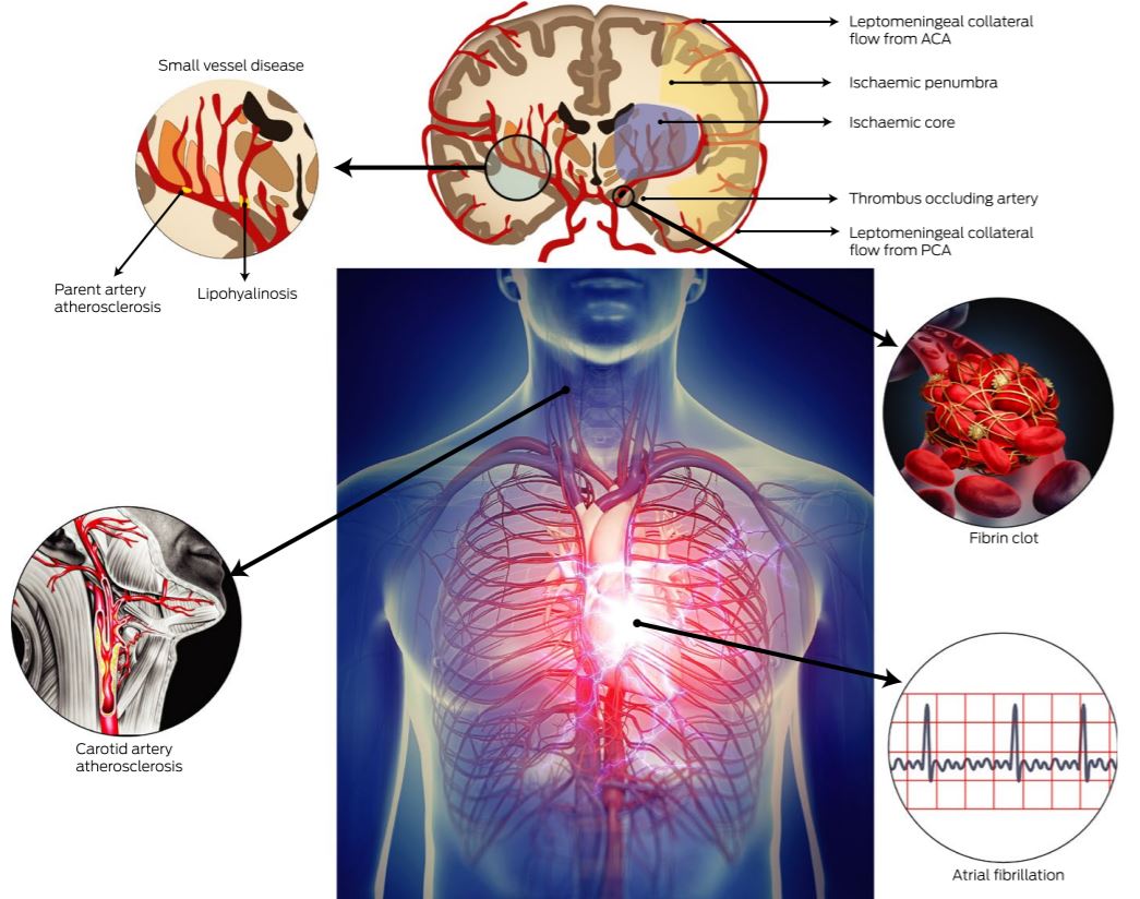 Scientific diagram showing the pathopyshiology of an ischaemic stroke.