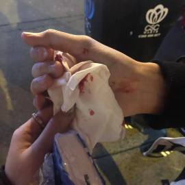 Mr Bi Sheng said he suffered a blood nose because of the attack.