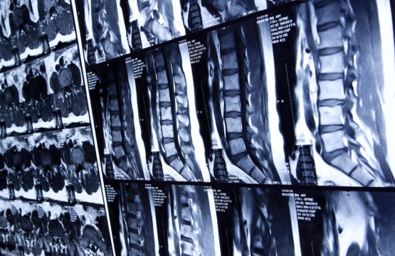 The prevailing MRI technique has only a 70 per cent image accuracy, compromising diagnosis.  Photo: Getty 