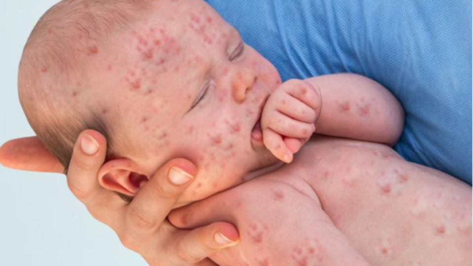measles texas