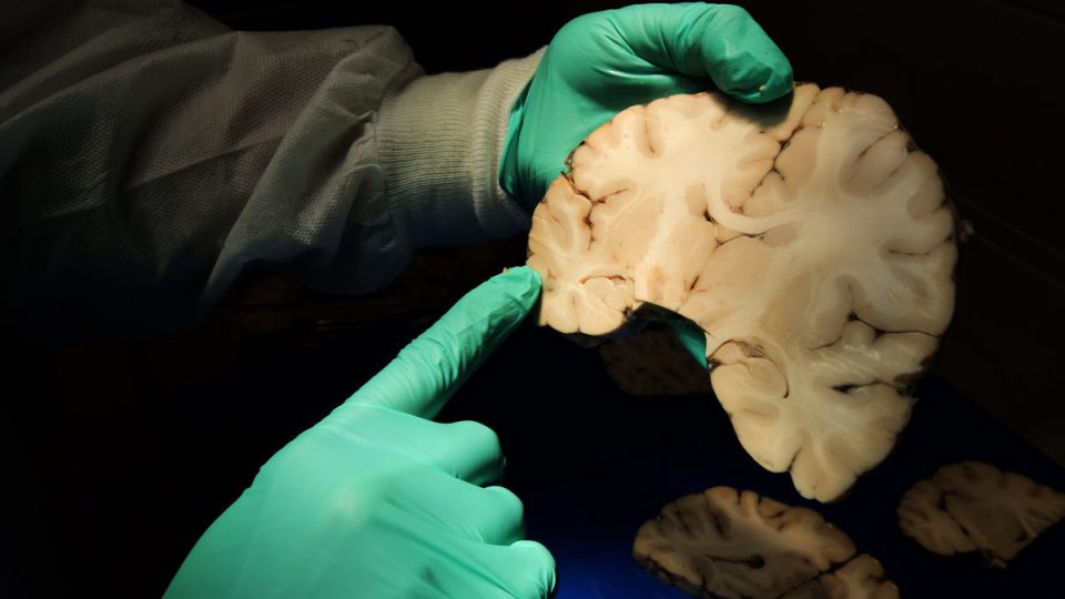 Dr. Ann C. McKee, Director of Boston Universitys CTE Center and Chief of Neuropathology at the VA Boston Healthcare System, analyzes brain tissue at the VA-BU-CLF Brain Bank in the Jamaica Plain neighborhood of Boston on May 31, 2017. Boston researchers who studied the brains of 202 deceased football players have published the most detailed portrait to date of the devastation wrought by a degenerative brain disease linked to repeated blows to the head. The study presents the largest number of CTE cases ever published and puts to rest any remaining arguments about whether the disease exists, said McKee, the studys lead author.