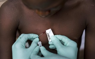 monkeypox spread