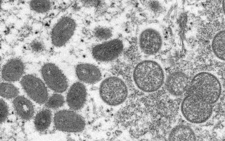 Monkeypox