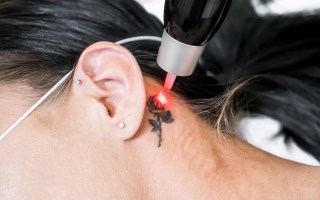 Tattoo removal