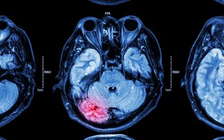 AFL concussion