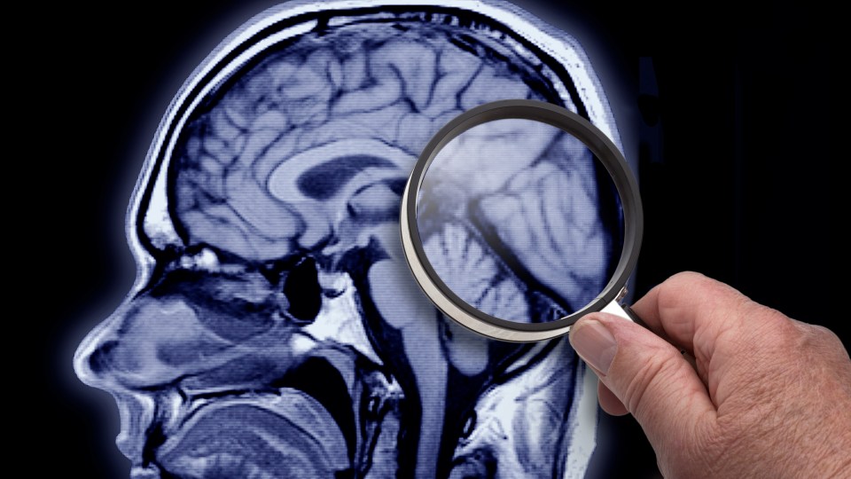 Alzheimer's