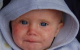 measles