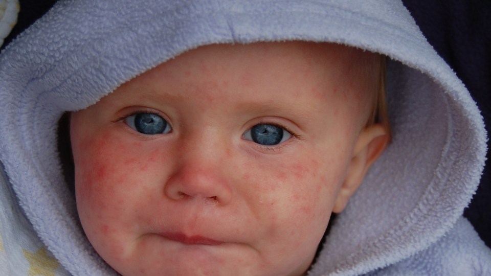 measles